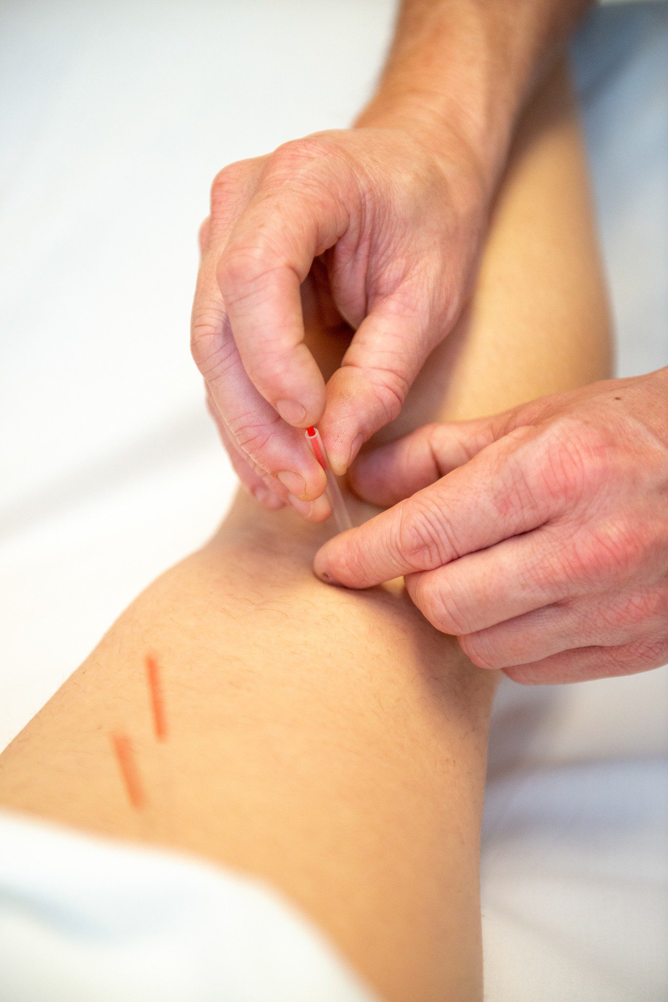 Acupuncture for osteoarthritis of the knee