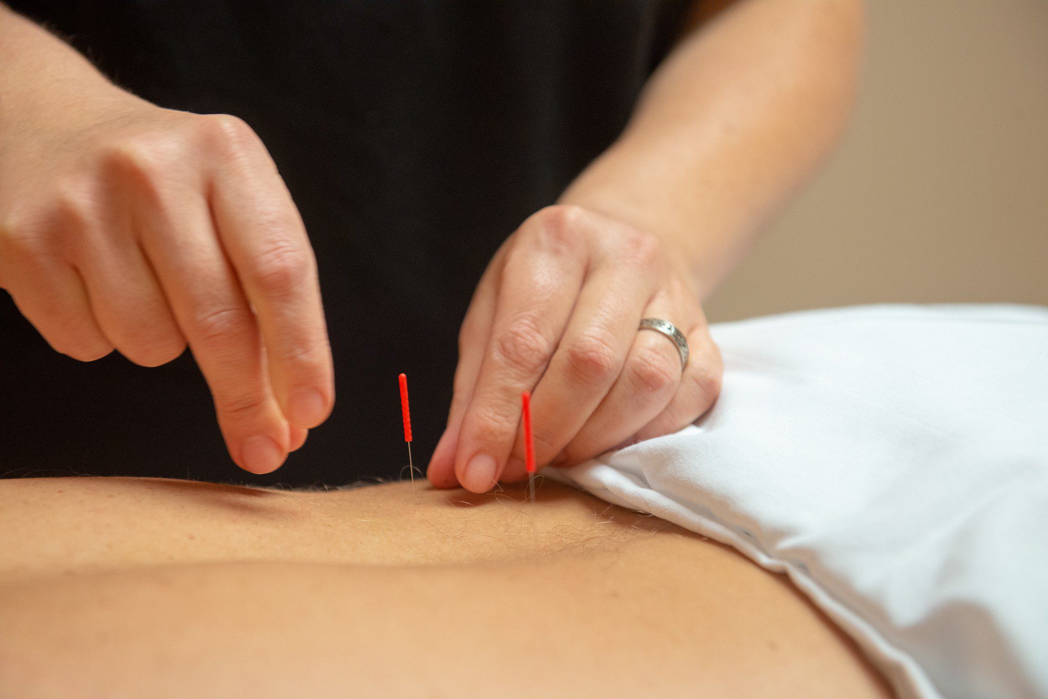 Acupuncture: Needling back
