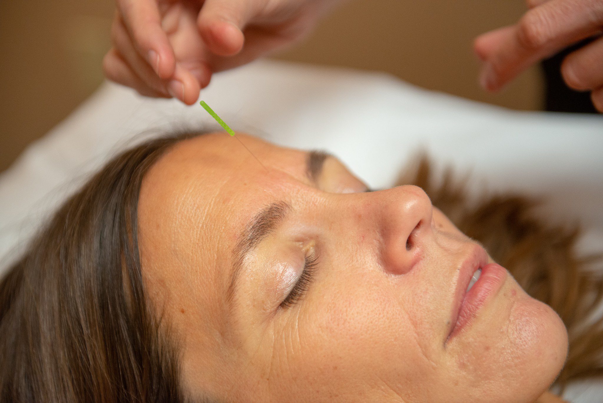 acupuncture needle place in between patient's eyebrows.
