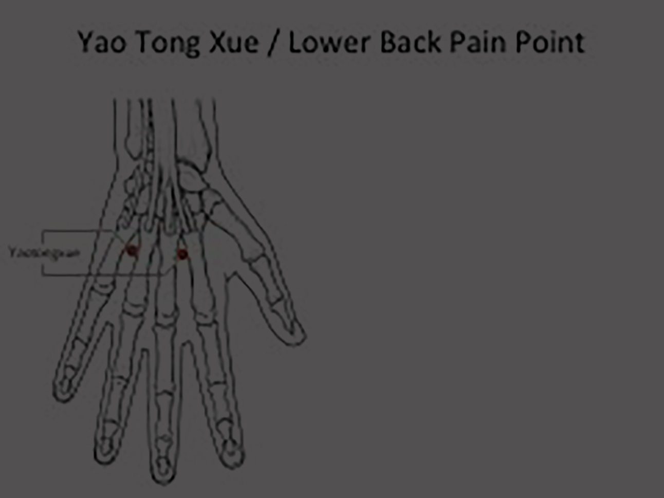 Acute, Severe Back Pain Treatment with Seated Acupuncture: A Clinical Pearl