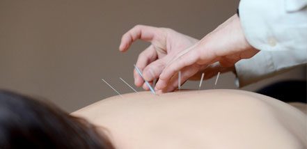 Needling Back