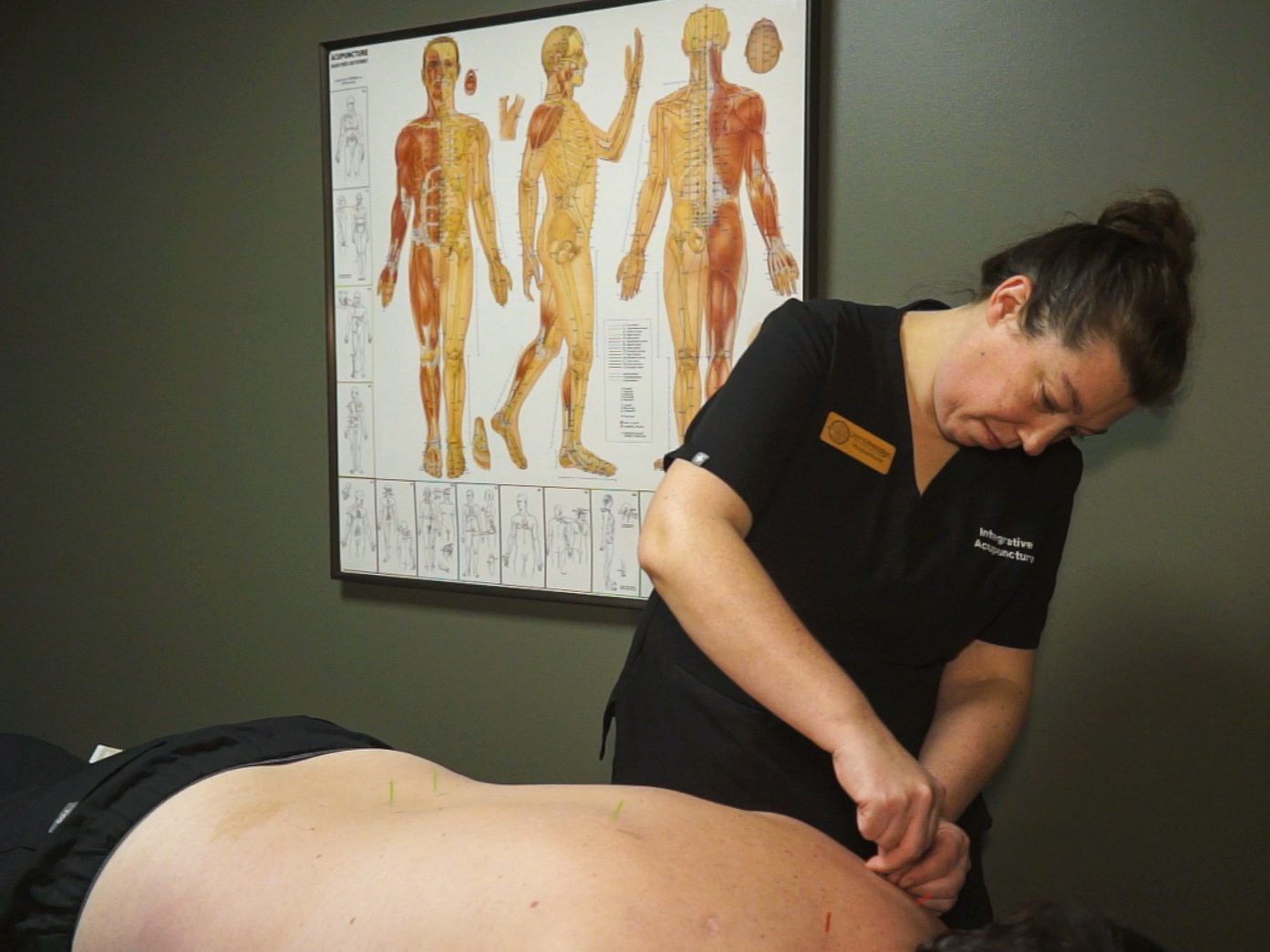 Acupuncturist placing needles on a patient's back