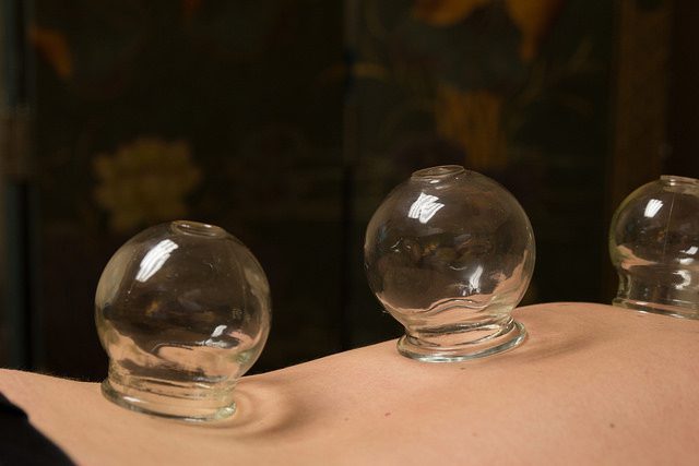 Cupping For Neck Pain