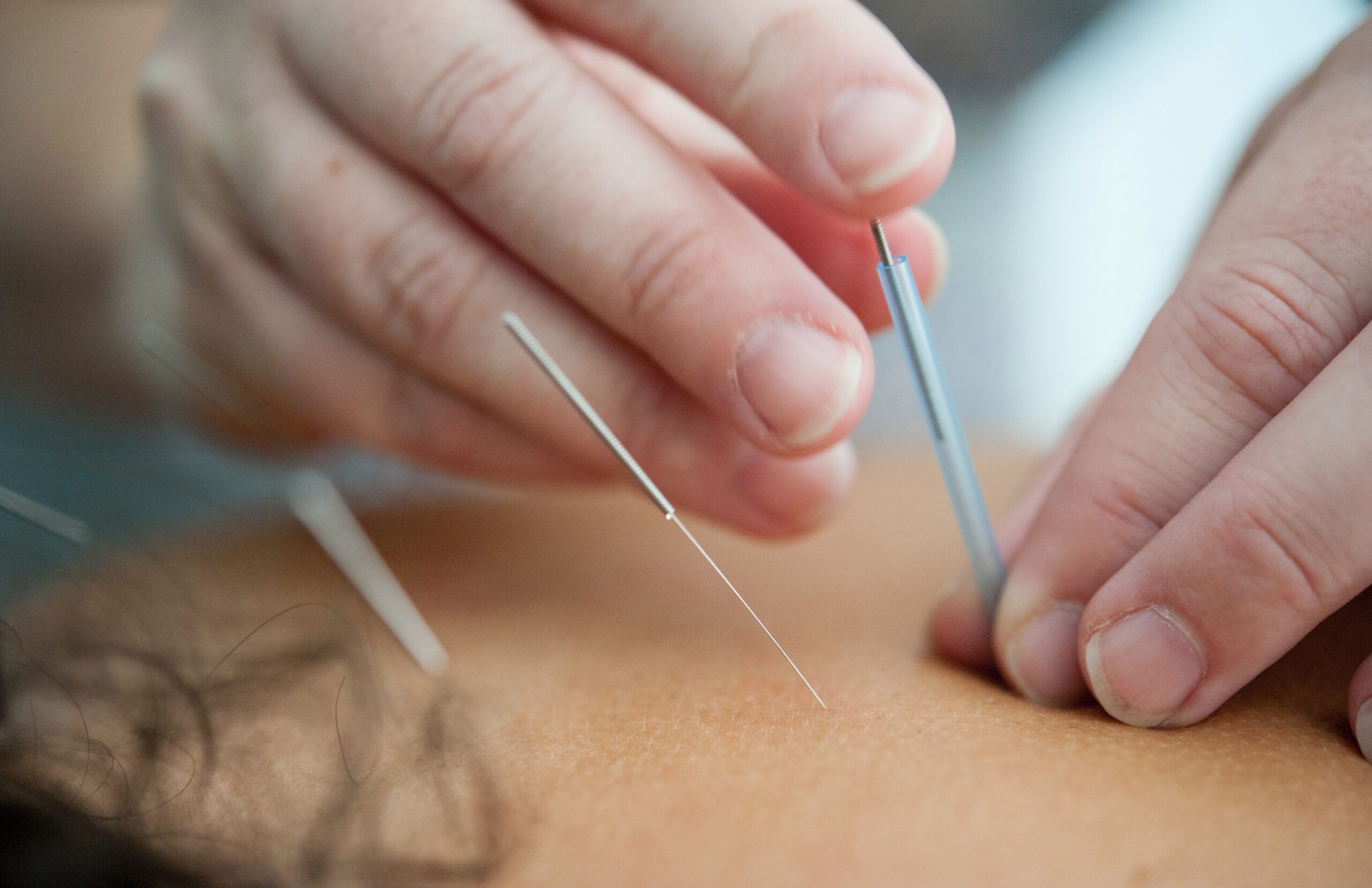 Placing acupuncture needles on patient's back.