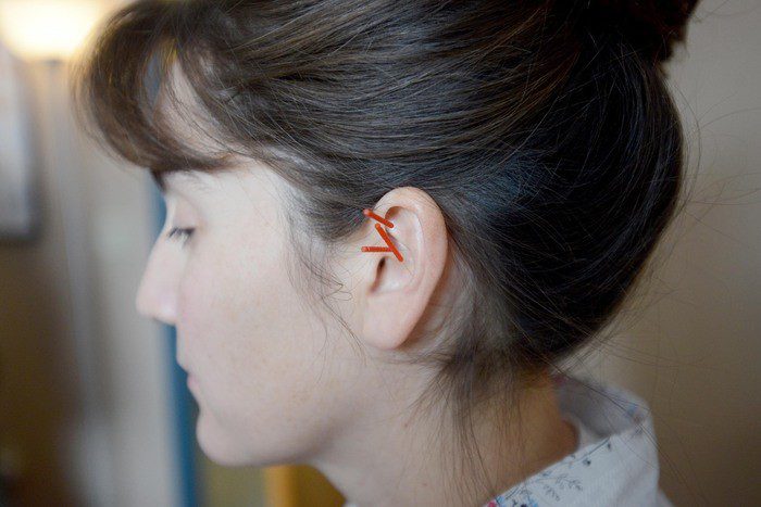 acupuncture needles placed in ear.