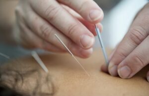 Placing acupuncture needles into back.