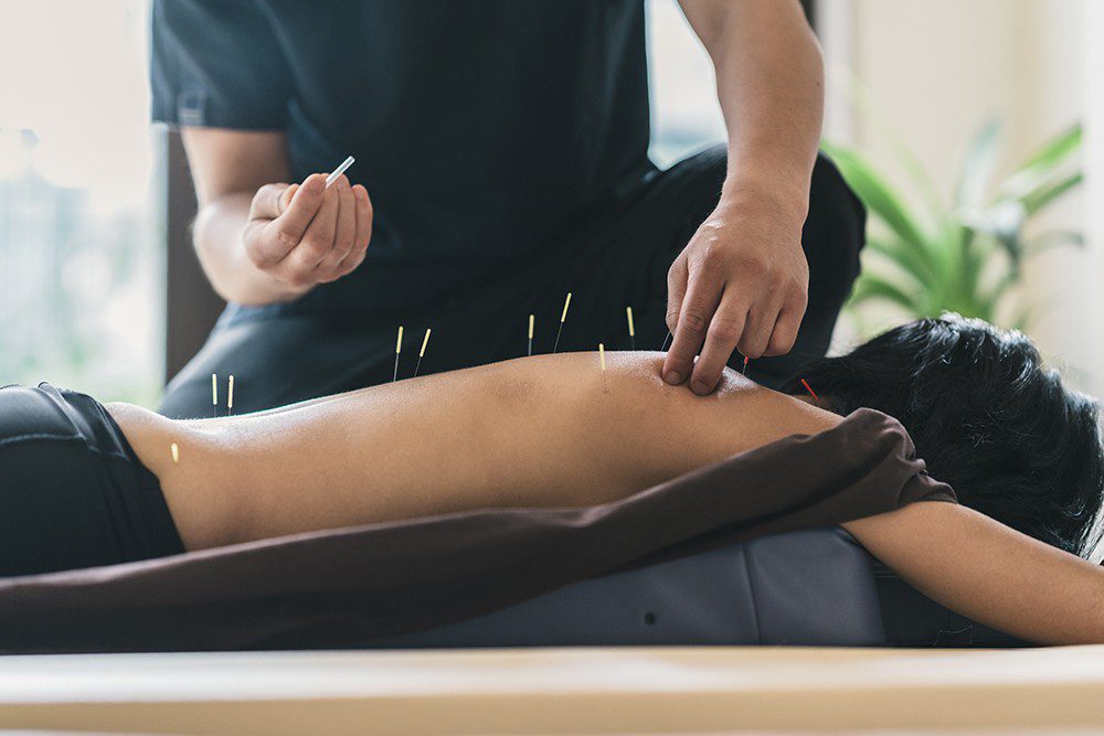 Person receiving acupuncture on back