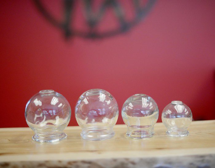 What Are The Benefits Of Cupping?