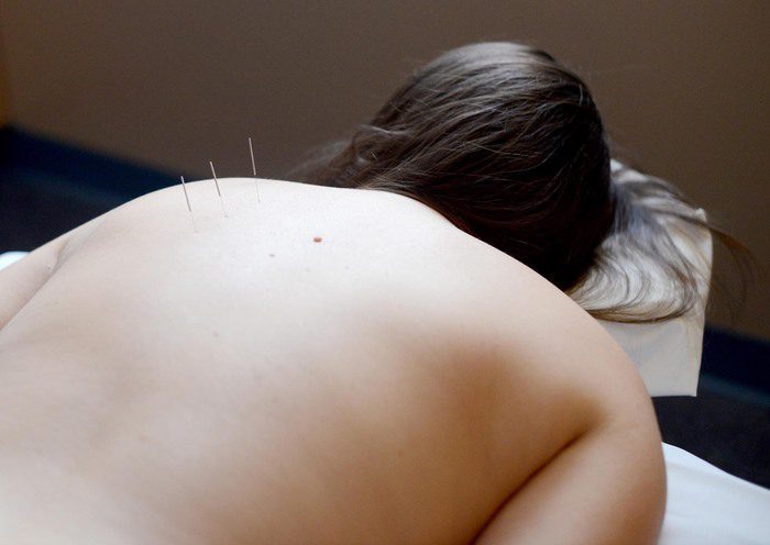 Endometriosis and Acupuncture- Can It Help?