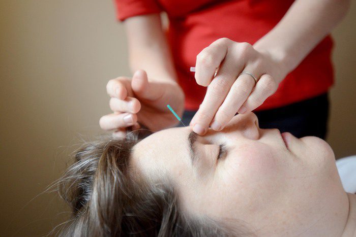Chronic  Headaches & Migraines- Evidence of Acupuncture Reducing